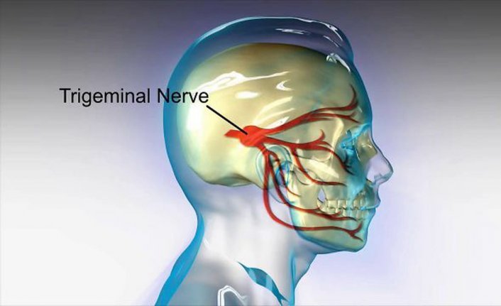 Trigeminal Nevralji